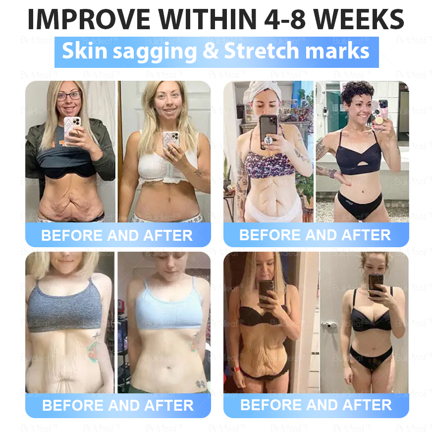 Official Store | Buildleaf® 🌿Tirzepatide Slimming & Health Nano Microneedle Patch |Targets Obesity, Loose Skin, High Blood Pressure, Diabetes, Fatty Liver, Joint Pain, Brain Fog, Low Energy, Body Aches, and More