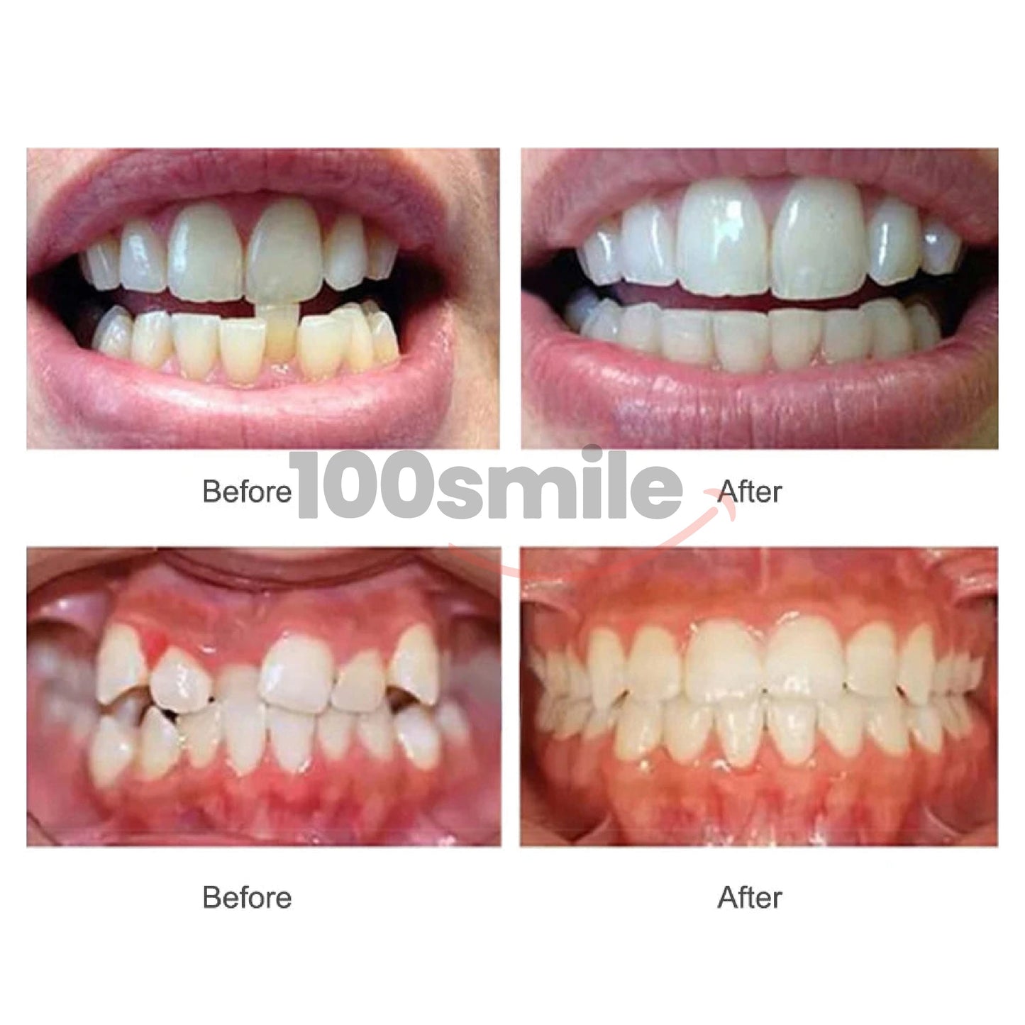 Ultra Aligner Smile Max Braces