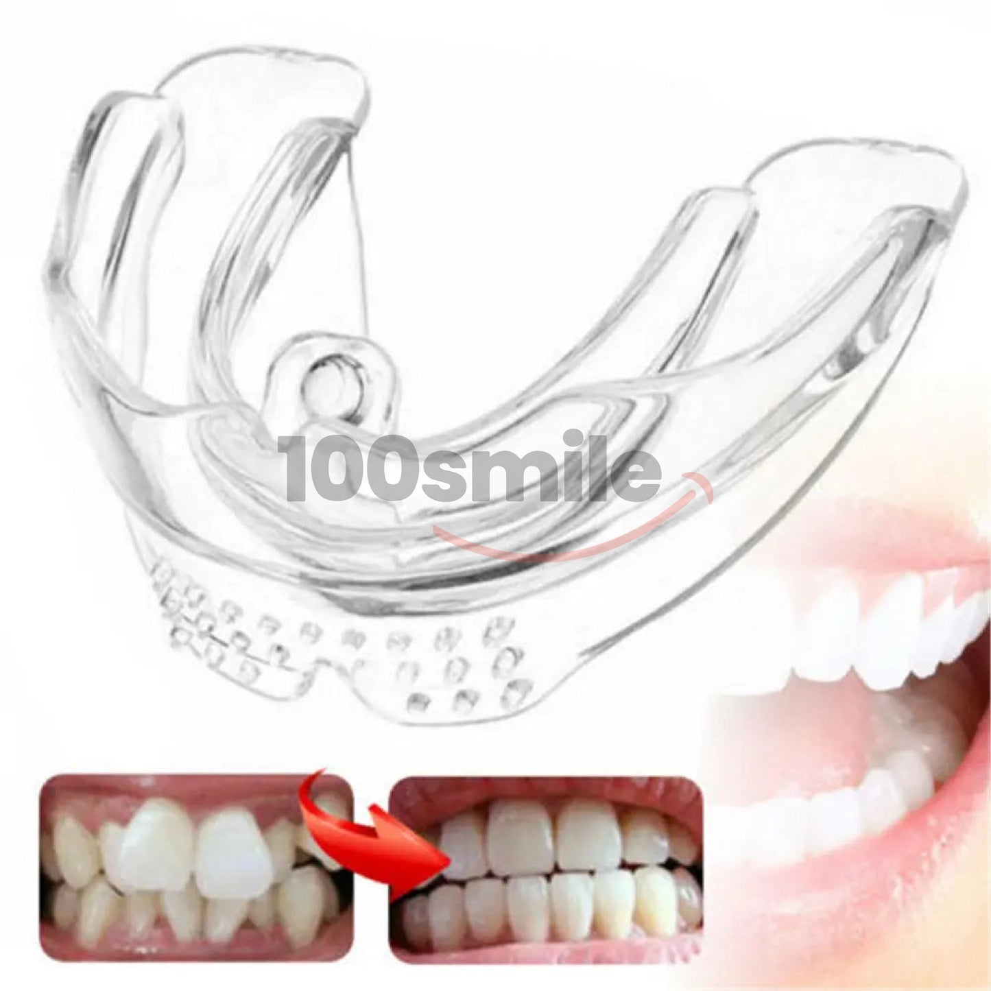 Ultra Aligner Smile Max Braces