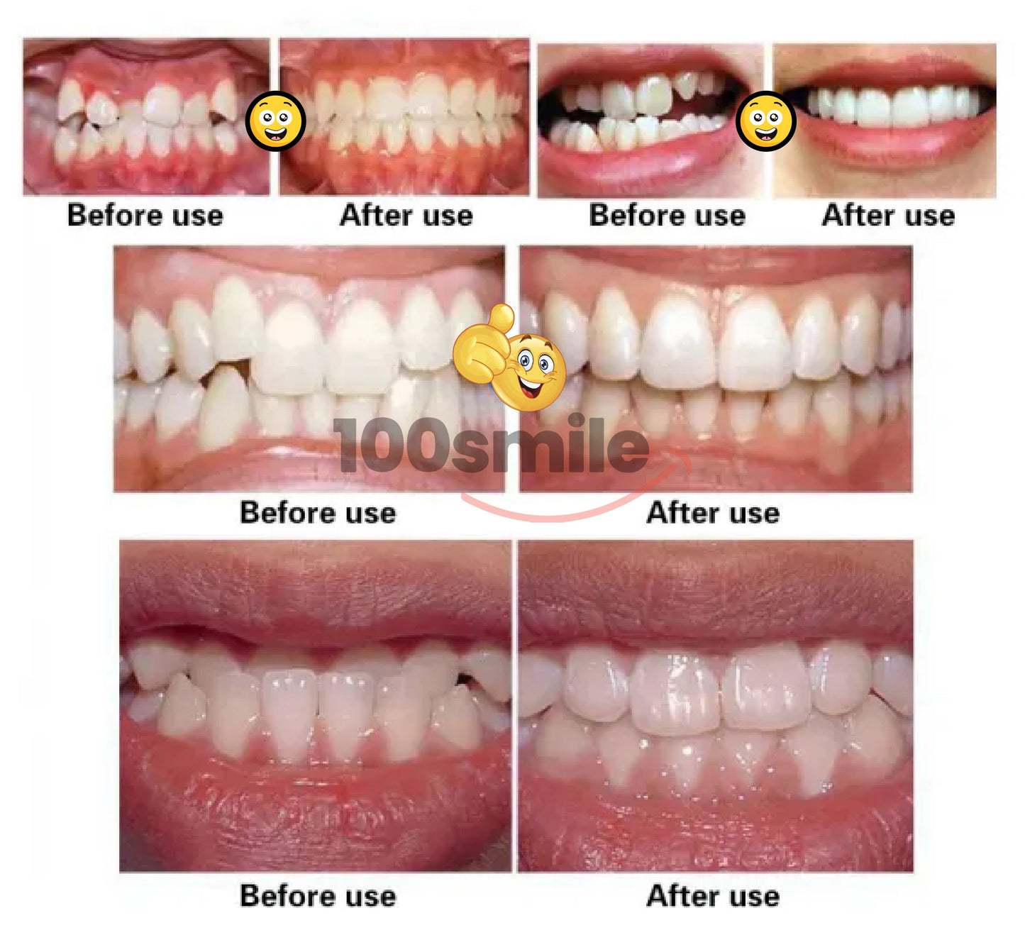 Ultra Aligner Smile Max Braces