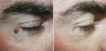 Natural Serum That Naturally Eliminates Moles & Skin Tags In 8 Hours Gets Biggest Deal In History