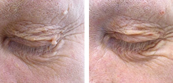 Natural Serum That Naturally Eliminates Moles & Skin Tags In 8 Hours Gets Biggest Deal In History