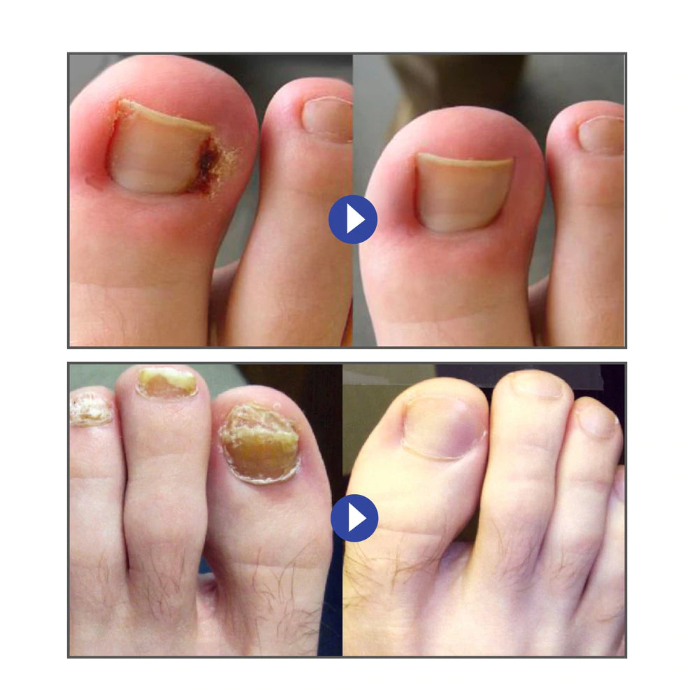 Health Toenail Corrector Patch【3 Day Delivery&Cash on delivery-HOT SALE-45%OFF🔥】
