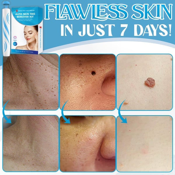 Auto-Micro Skin Tag Remover【Maha Shivaratri/Holi Offer-40%】