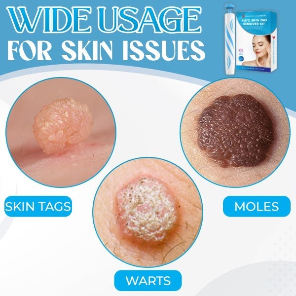 Auto-Micro Skin Tag Remover【Maha Shivaratri/Holi Offer-40%】