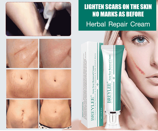 [Awarded International Award for Acne Scar Removal] Herbal Acne Scar Removal Repair Cream