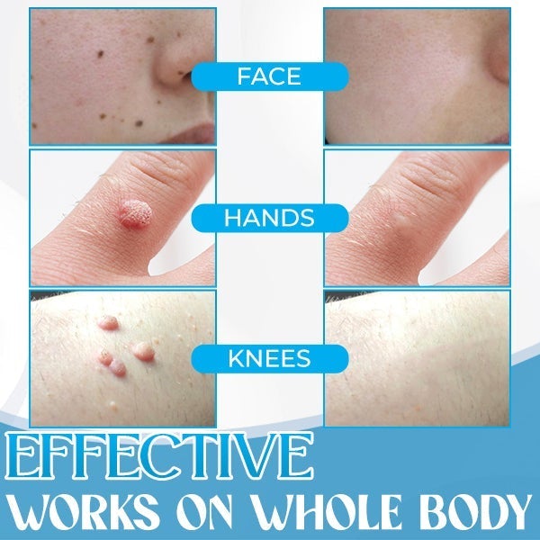 Auto-Micro Skin Tag Remover【Maha Shivaratri/Holi Offer-40%】